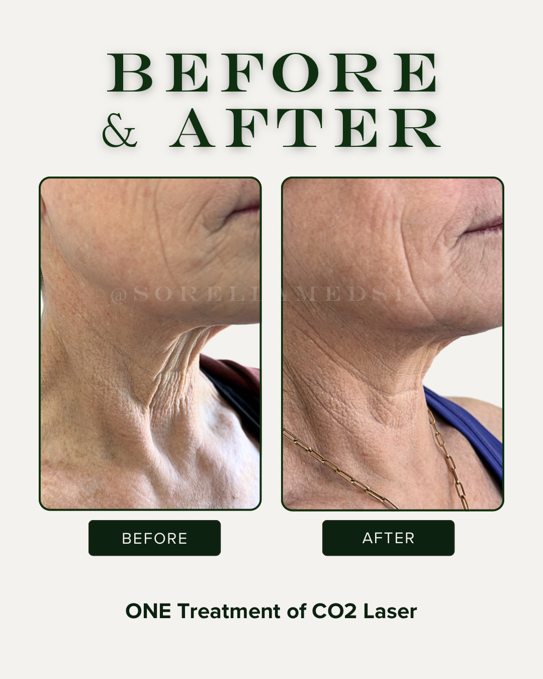 CO2 Laser Resurfacing Denver & Lone Tree | Tetra Pro | Sorella Med Spa
